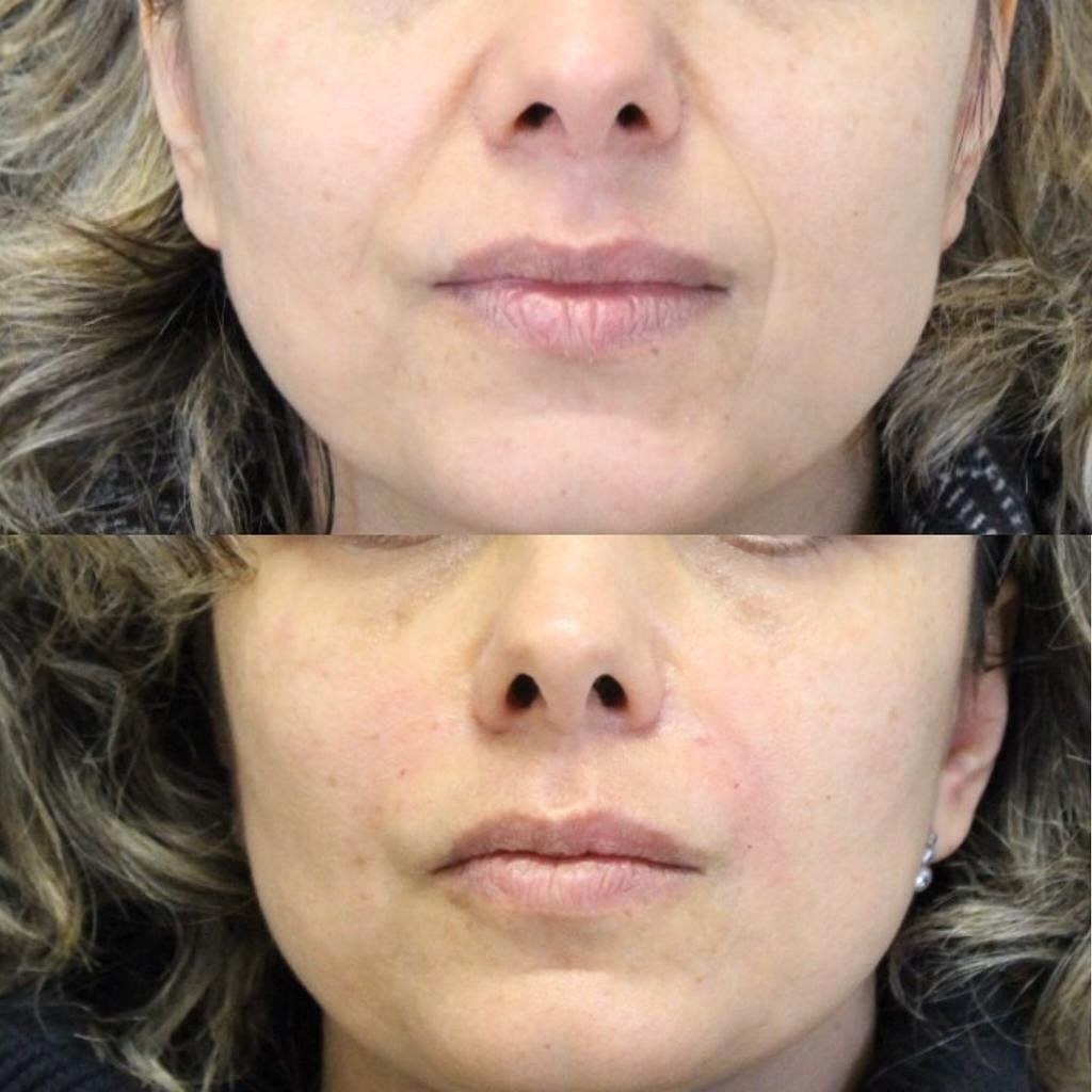 Sérum Visage 5-en-1 repulpant et régénérant